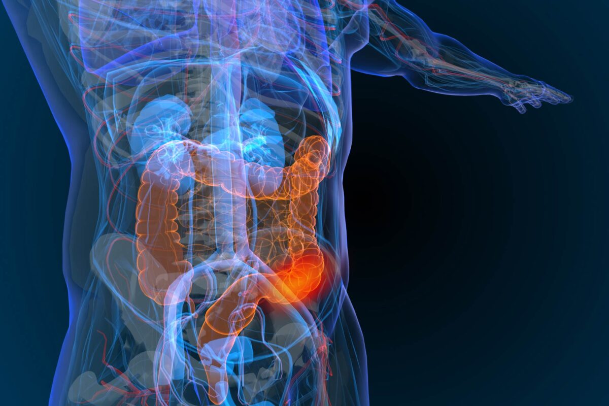 colorectal-cancer-1200x800.jpg