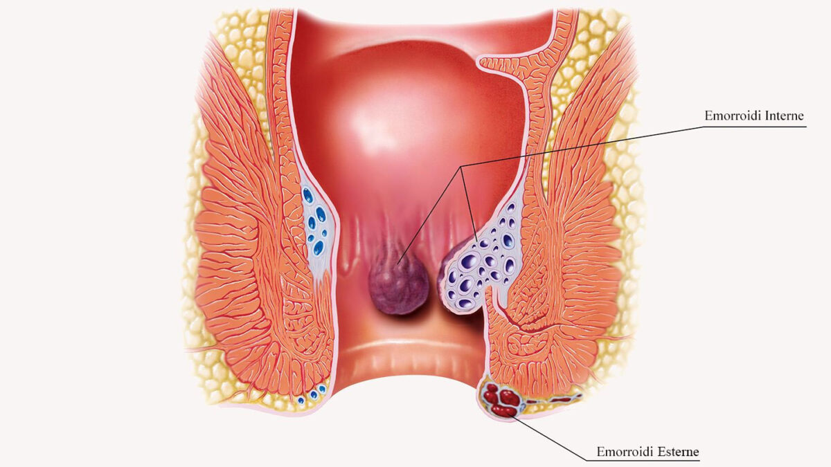 emorroidi-1200x675.jpg