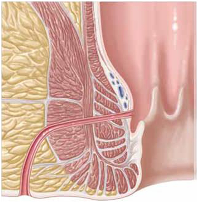 Schematic-drawing-of-a-transsphincteric-anal-fistula.png.jpeg