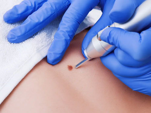 Interventi-Chirurgici-su-Nei-Cisti-sebacee-lipomi-e-Lesioni-della-pelle-e-del-tessuto-sottocutaneo-Approfondimento-a-cura-del-Dott.-Guido-Coretti-a-Napoli-e-Caserta-1.jpg