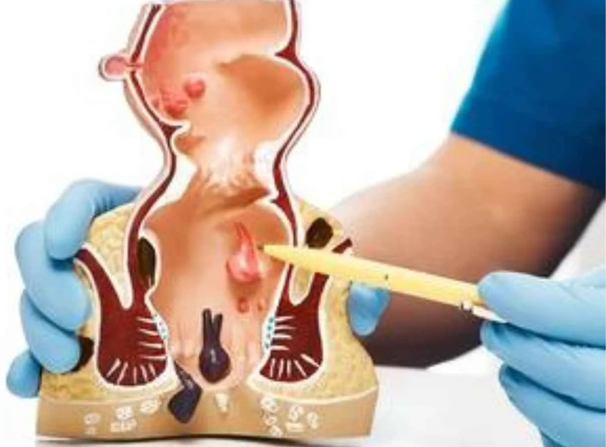 Fistola Perianale: Il Trattamento con Tecnica Laser del Dott. Guido Coretti
