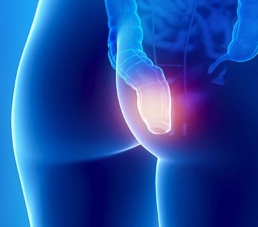 Trattamento Laser della Fistola Sacrococcigea: La Soluzione Minimamente Invasiva per Napoli e Caserta